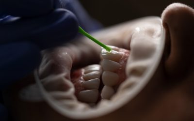 Consejos prácticos para una endodoncia: Guía completa