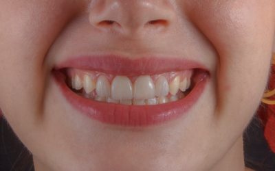 Qué esperar de una cirugía oral en Sevilla: guía completa con Dental Buhaira